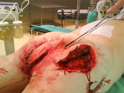 20100104_Rozlegle-rany-szarpane-posladkow-Przygotowanie-do-leczenia-operacyjnego